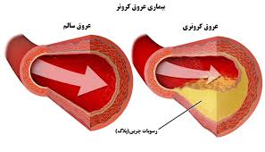 پاورپوینت بیماری عروق کرونر (ppt) 128 اسلاید