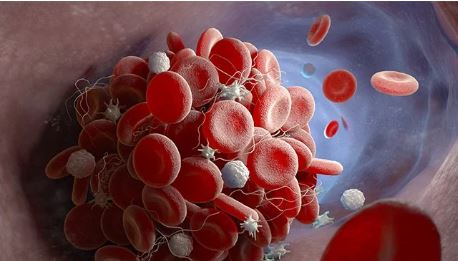 پاورپوینت لنفوما و مالتیپل میلوما