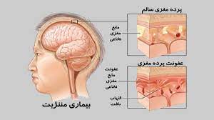 اسلاید آموزشی با عنوان مننژیت