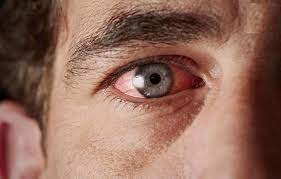 پاورپوینت گلوکوم