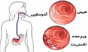 اسلاید آموزشی با عنوان ورم معده