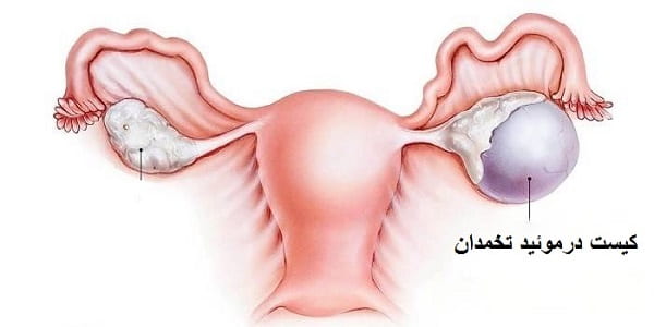 دانلود پاورپوینت معرفی کیست درموئید تخمدان